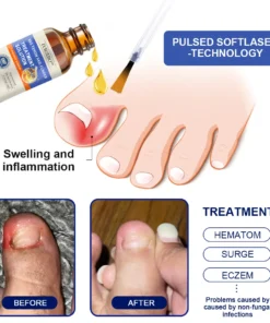 Furzero™ Bee Venom Nail Folliculitis Treatment