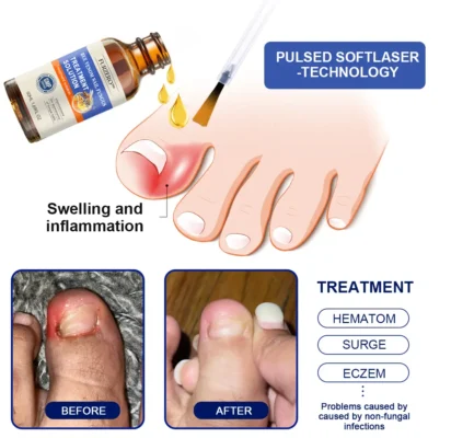 Furzero™ Bee Venom Nail Folliculitis Treatment