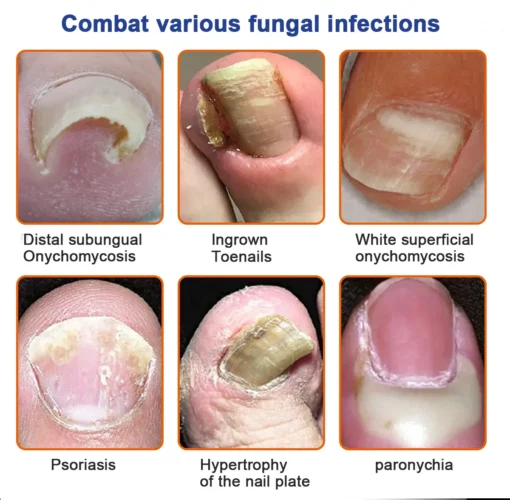 Furzero™ Bee Venom Nail Folliculitis Treatment