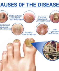 Furzero™ PureNail Fungus Laser Device