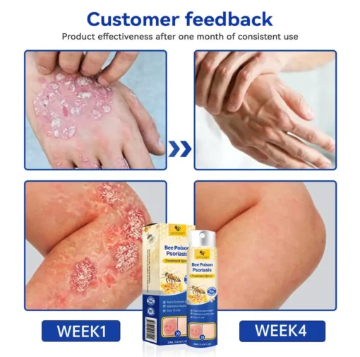 LOVILDS™ PsoriaHeal Bee poison Psoriasis Treatment Spray pro