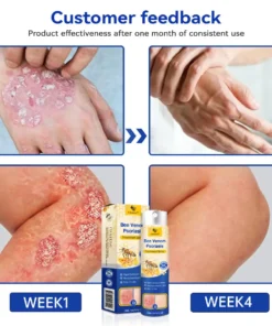 Ourlyard™ Bee Venom Advanced Psoriasis Treatment Cream