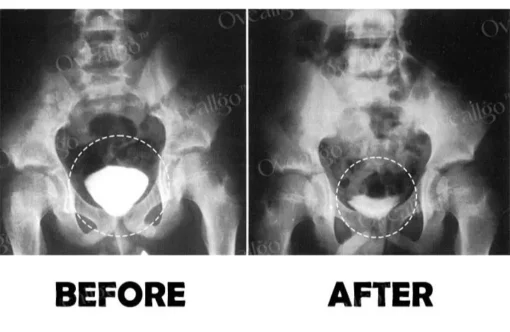 Oveallgo™ ProstaNasal Boost Portable Device