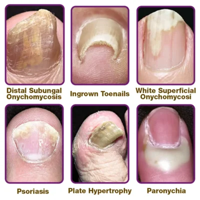 flysmus™ FungiFree Anti-fungal Bee Venom Nail Serum