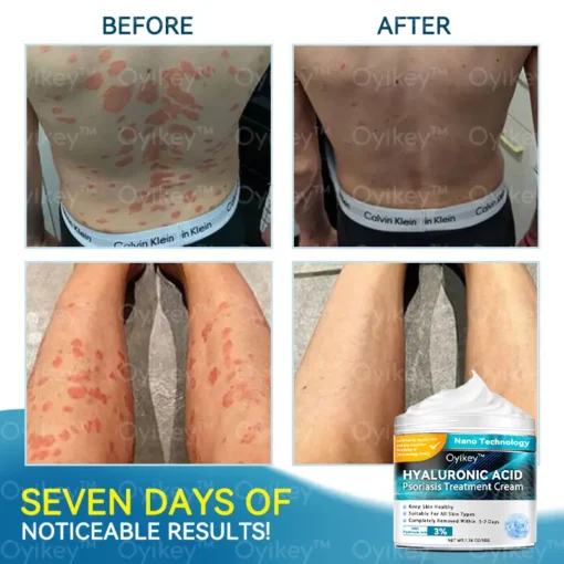 𝐎𝐲𝐢𝐤𝐞𝐲™ Hyaluronic Acid Psoriasis Treatment Cream