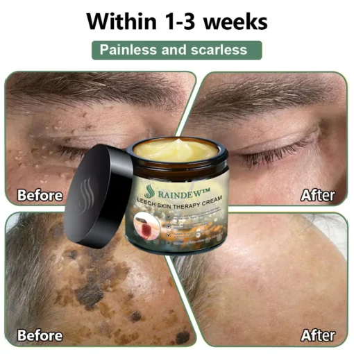 RAINDEW™ Leech Skin Treatment Cream